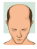 Stage 2 : Hair fall solution