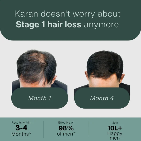 Hair Fall Stage 1: The Starter Kit